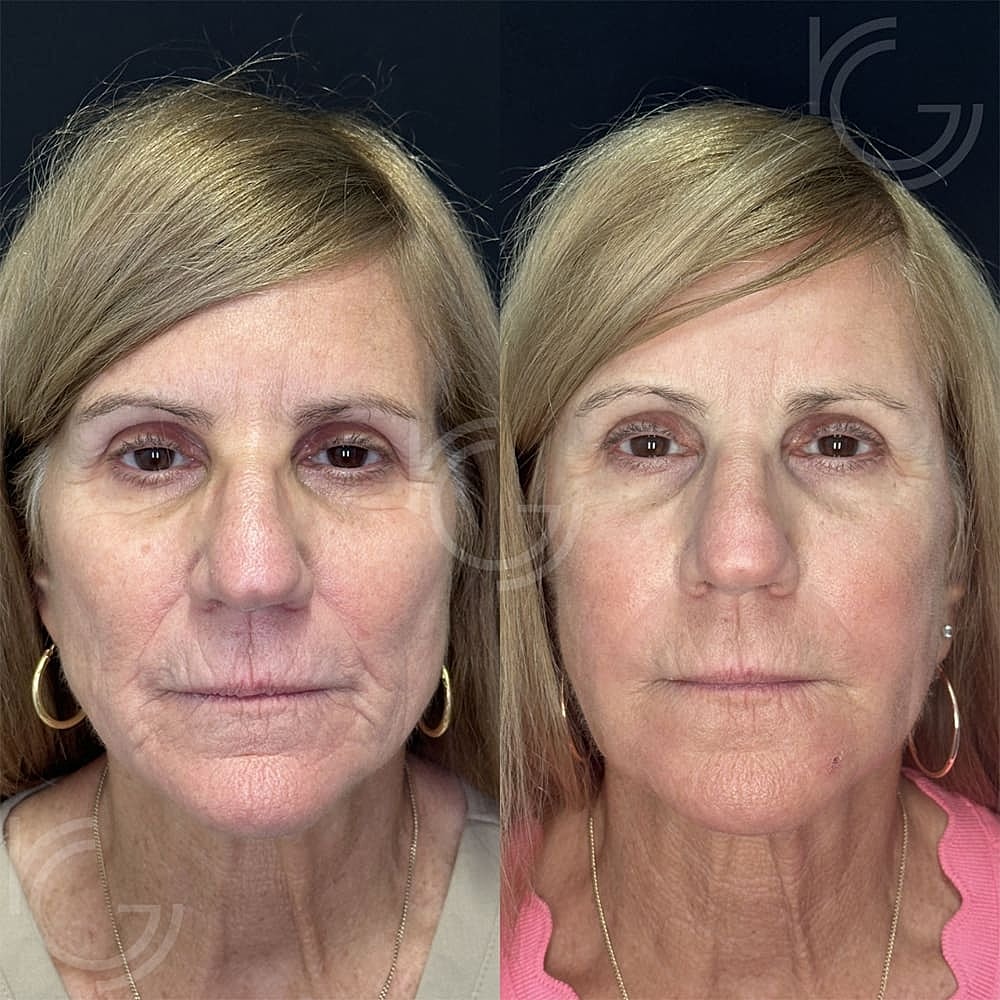 Laser Skin Resurfacing Before & After