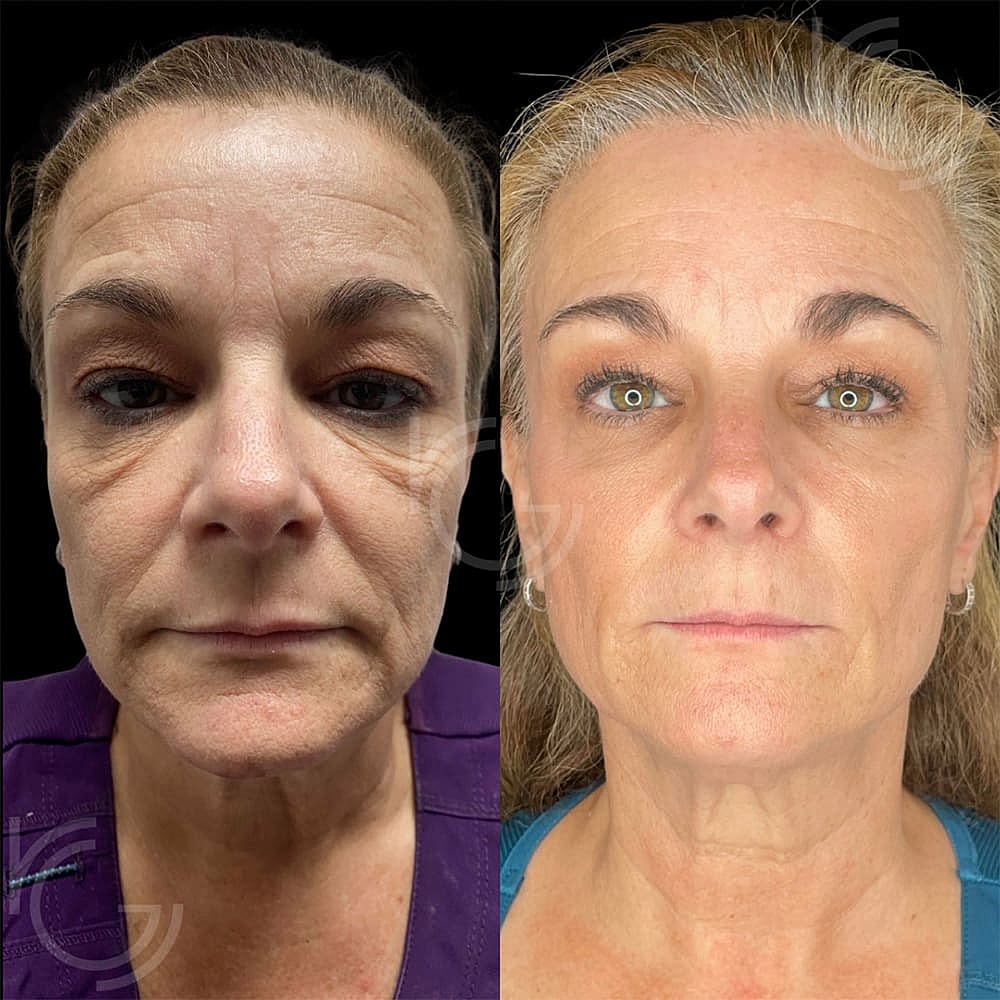 Morpheus8 Before & After