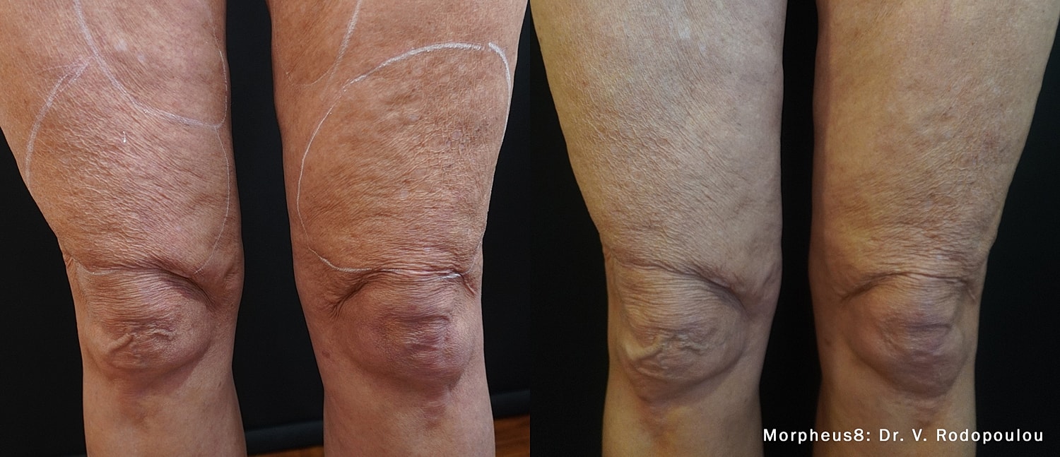 Morpheus8 Body Before & After