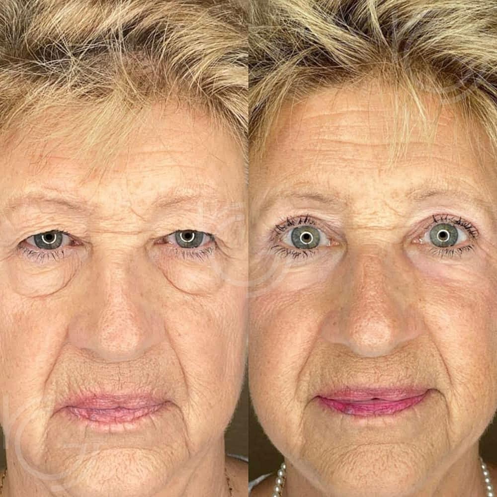 Upper Eyelid Surgery Before & After
