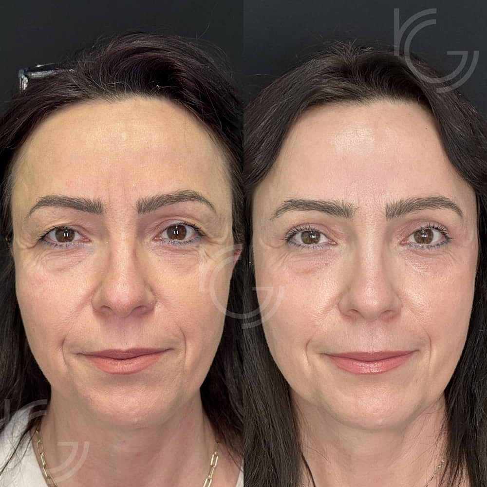 Upper Eyelid Surgery Before & After