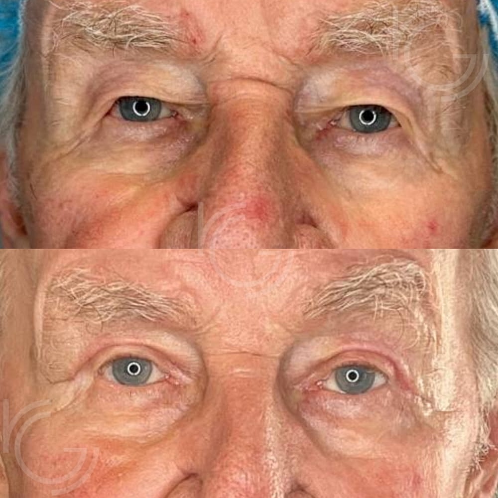 Upper Eyelid Surgery Before & After