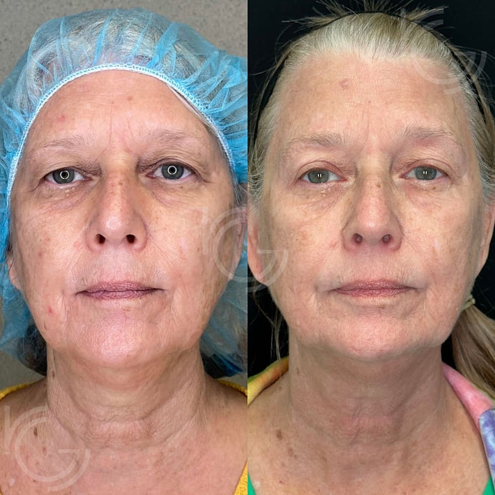 Upper Eyelid Surgery Before & After