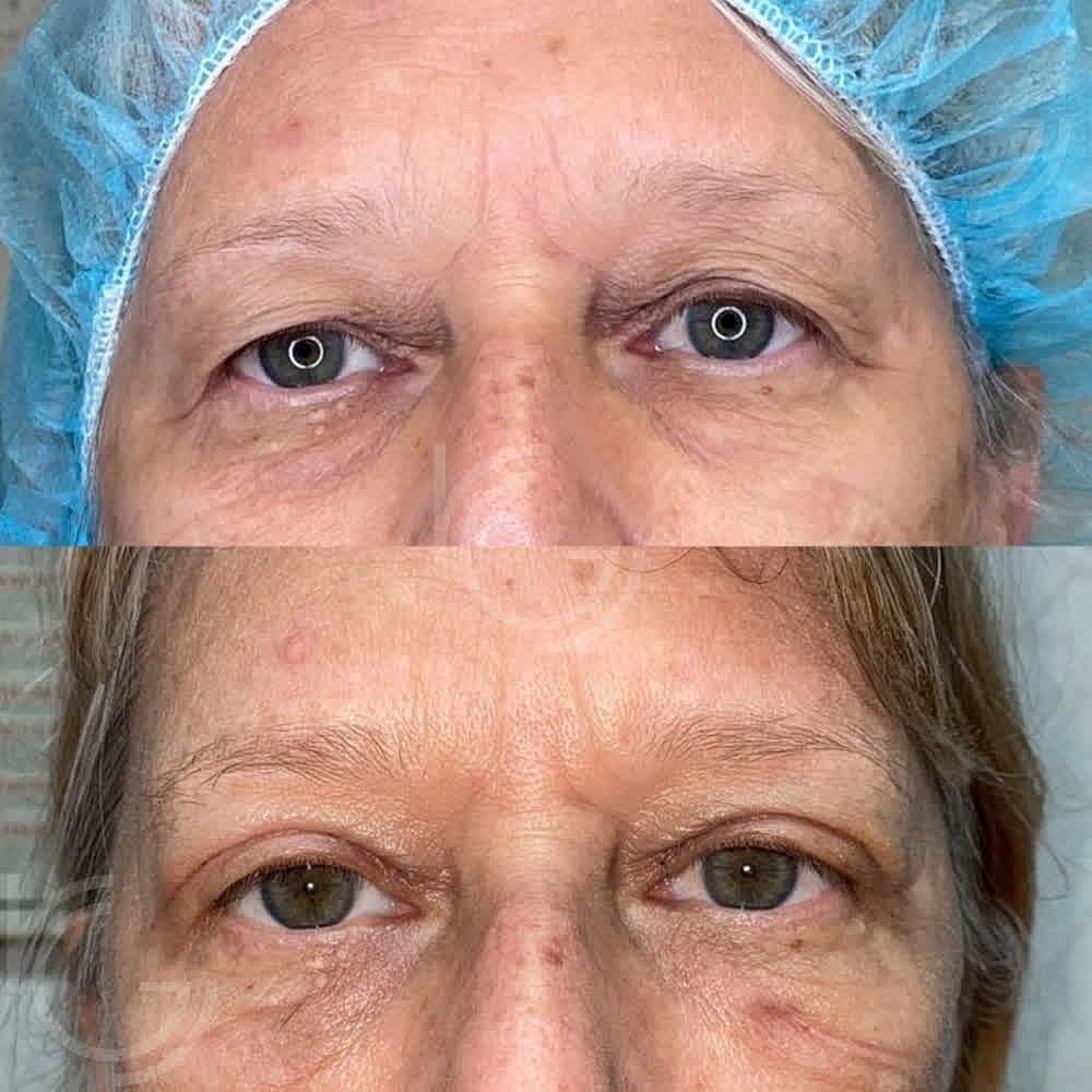 Upper Eyelid Surgery Before & After
