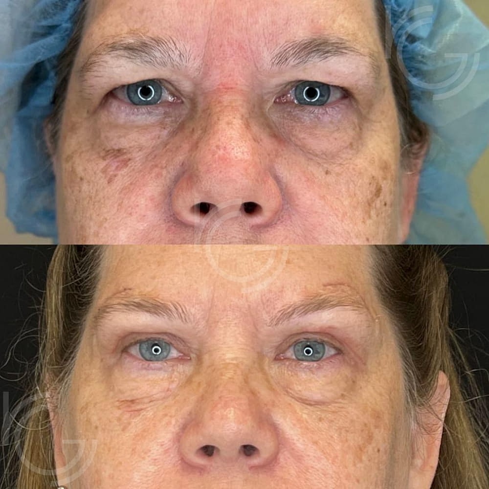 Upper Eyelid Surgery Before & After