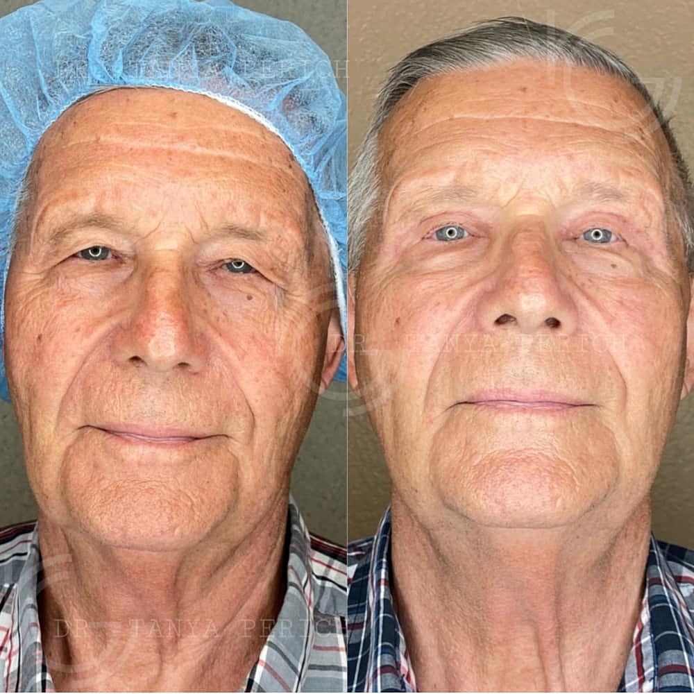 Upper Eyelid Surgery Before & After