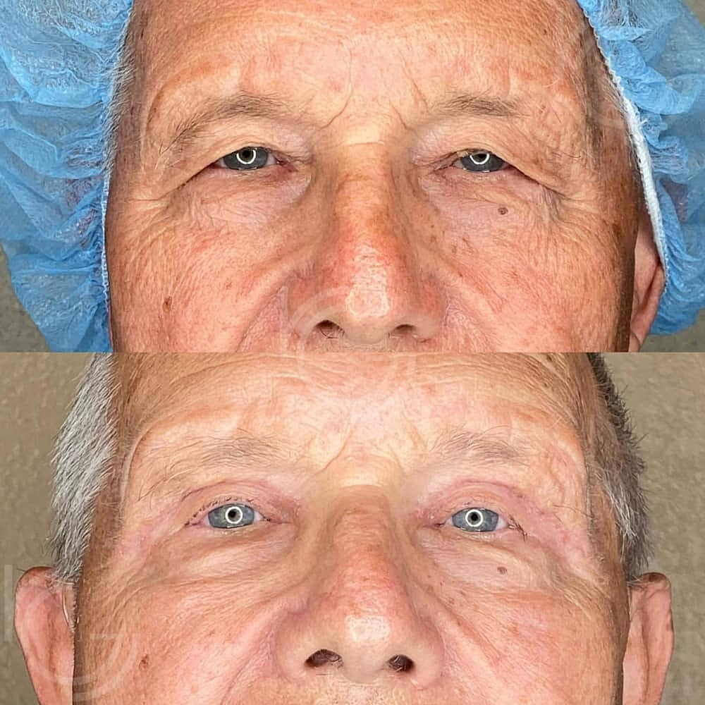 Upper Eyelid Surgery Before & After
