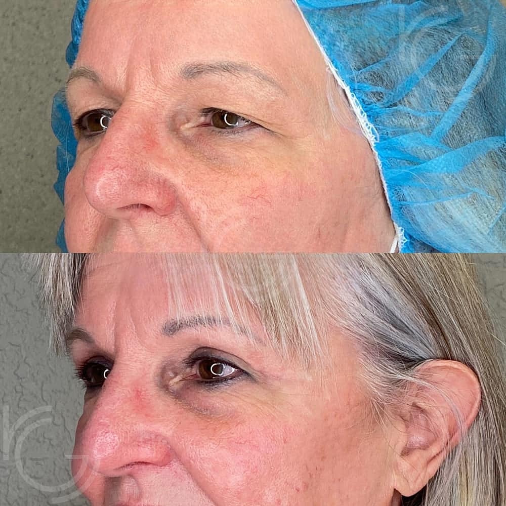 Upper Eyelid Surgery Before & After