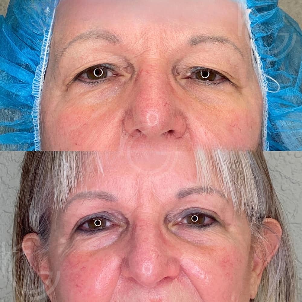 Upper Eyelid Surgery Before & After