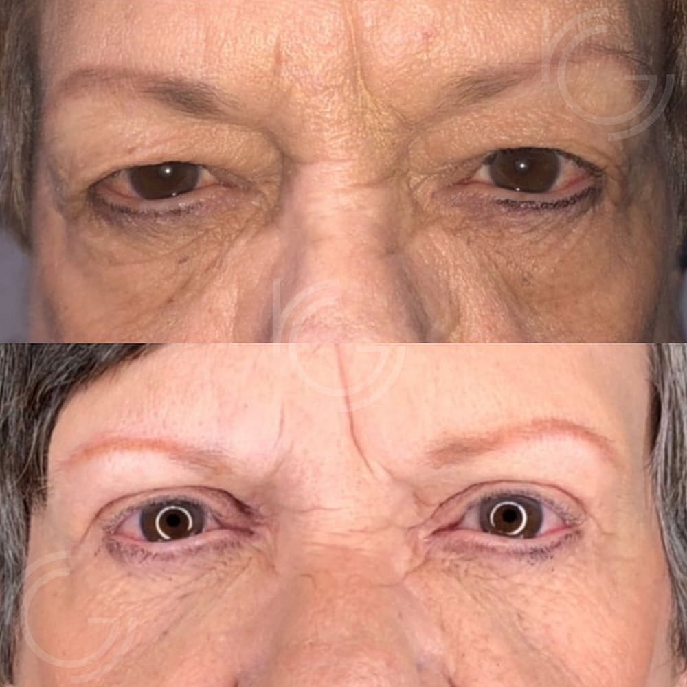 Upper Eyelid Surgery Before & After