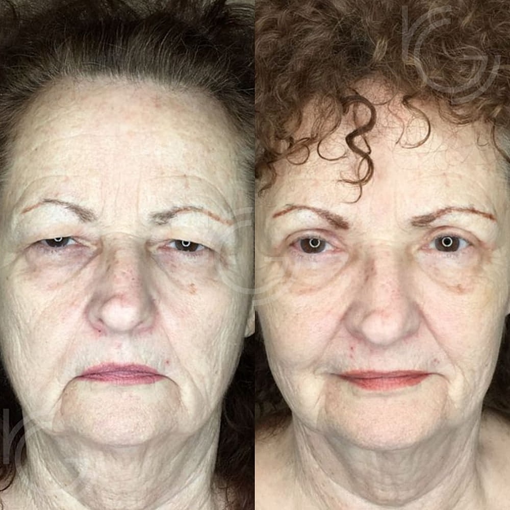Upper Eyelid Surgery Before & After
