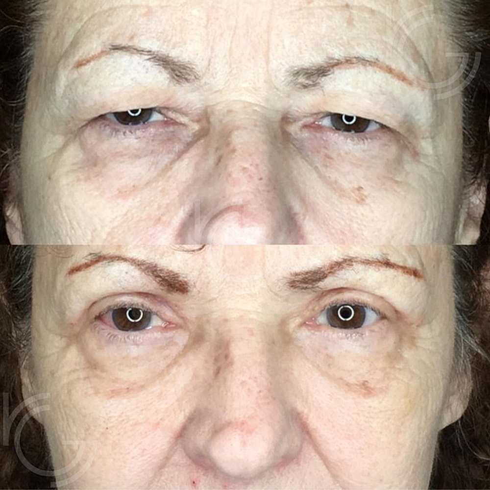 Upper Eyelid Surgery Before & After