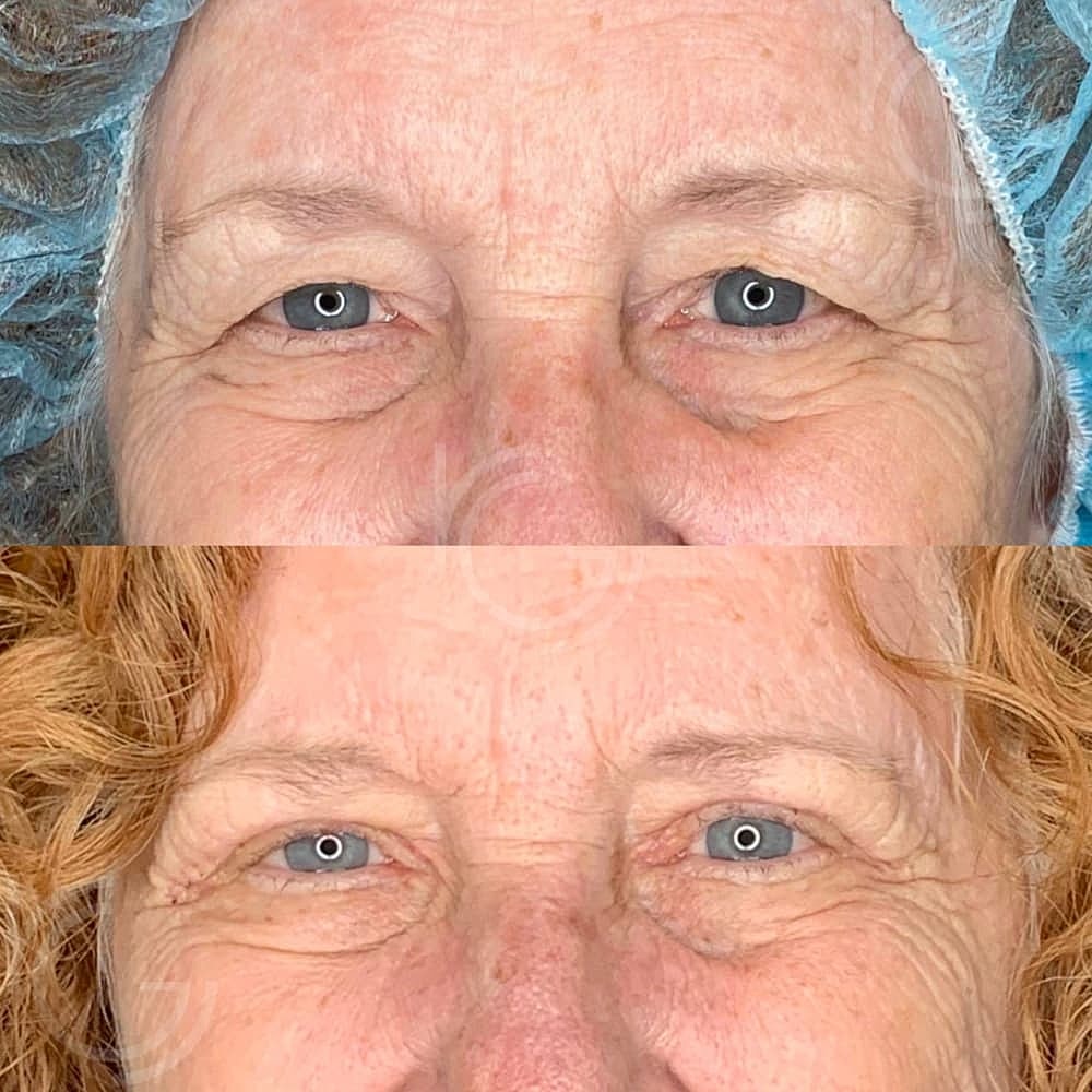 Upper Eyelid Surgery Before & After