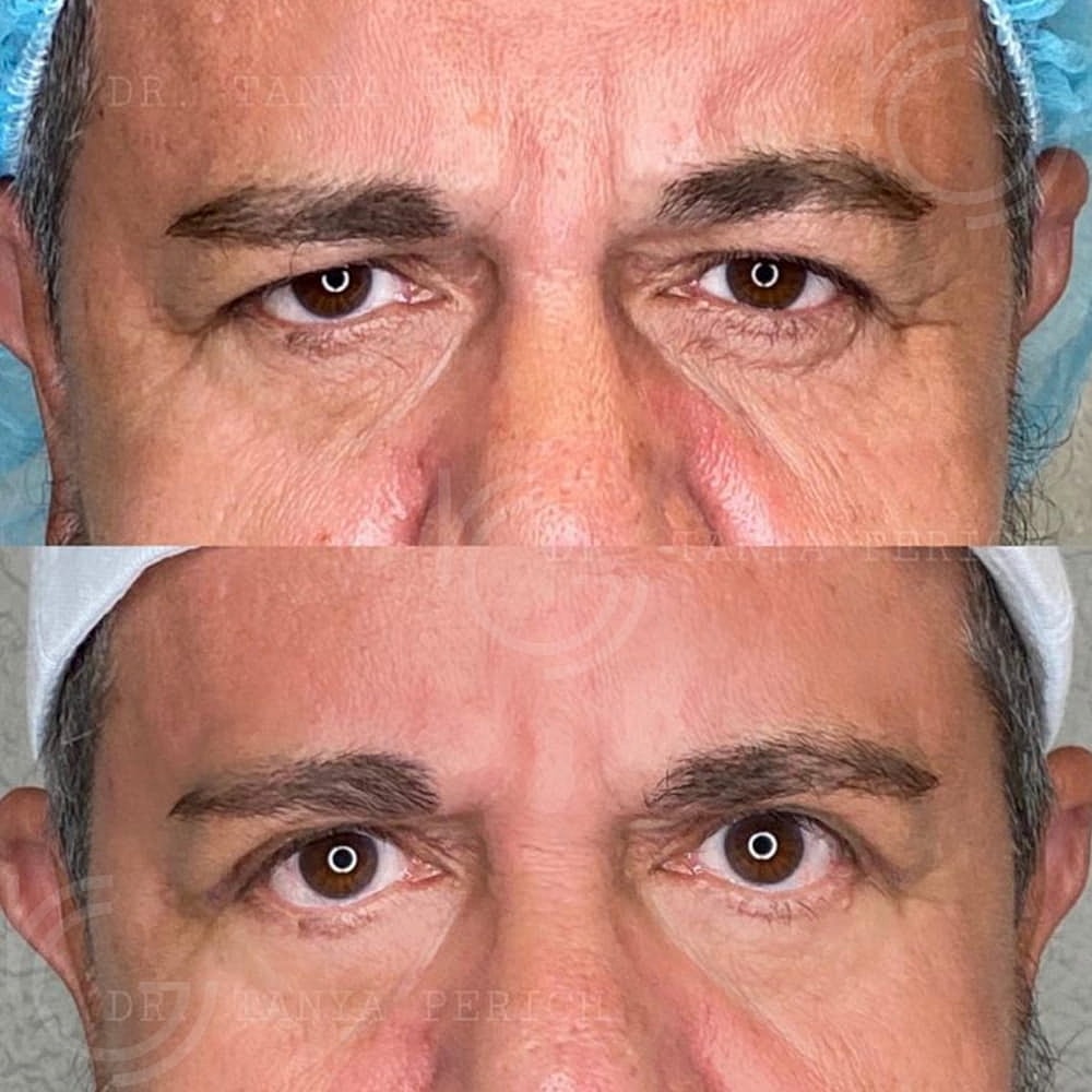 Upper Eyelid Surgery Before & After