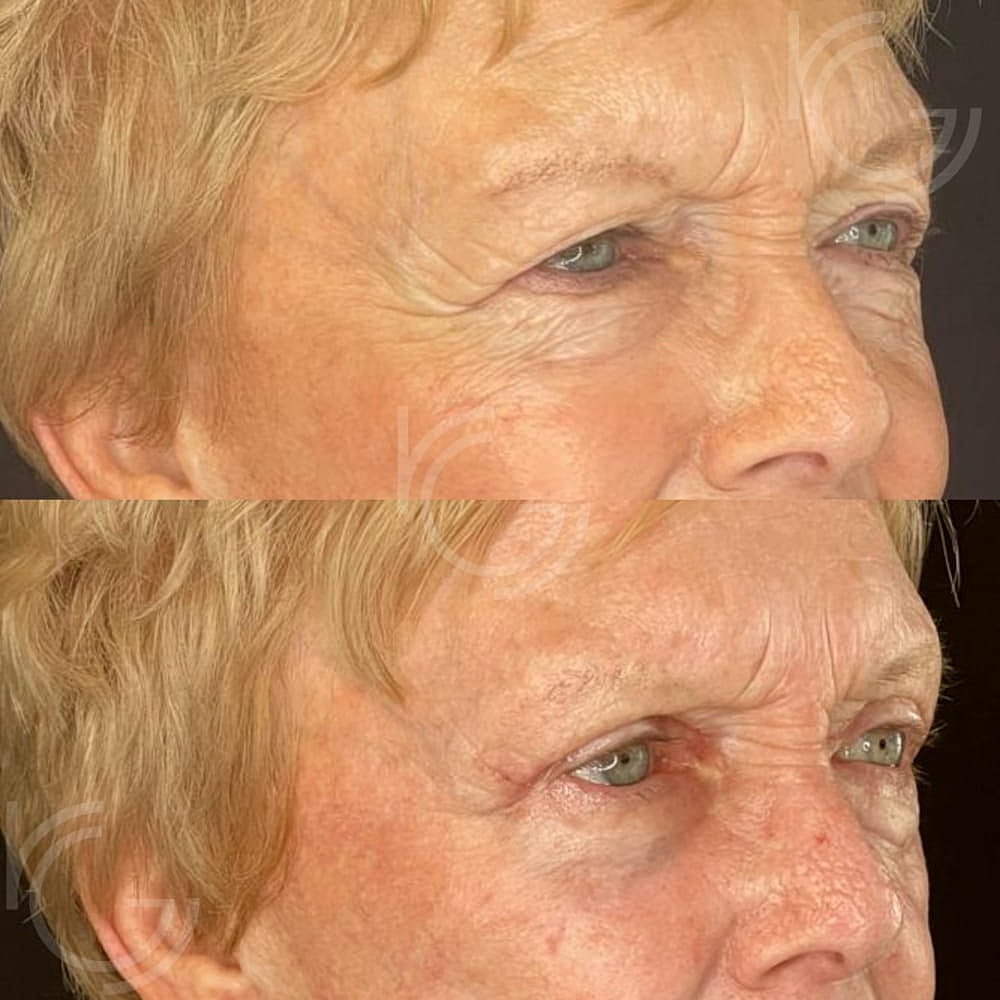 Upper Eyelid Surgery Before & After