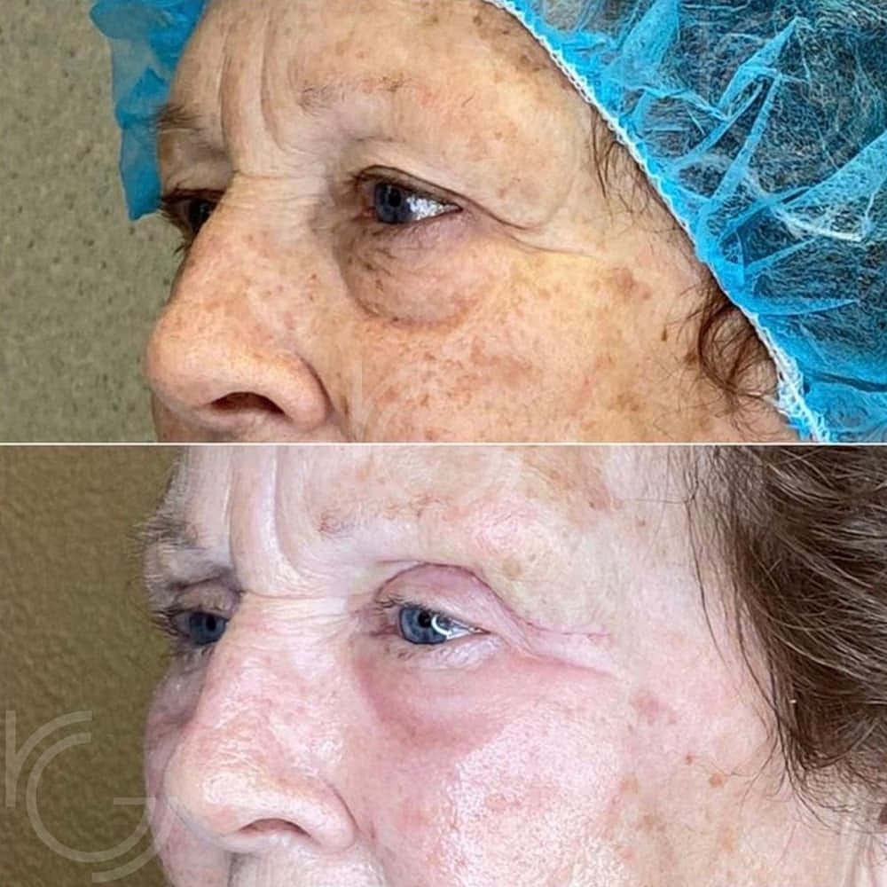 Upper Eyelid Surgery Before & After