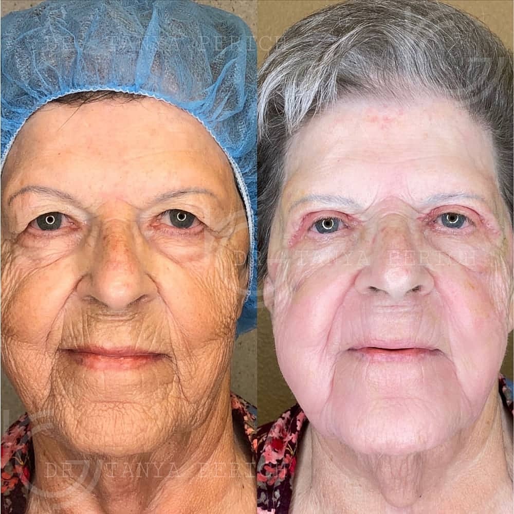 Upper Eyelid Surgery Before & After