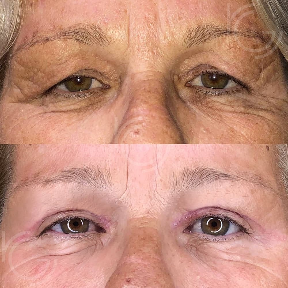 Upper Eyelid Surgery Before & After