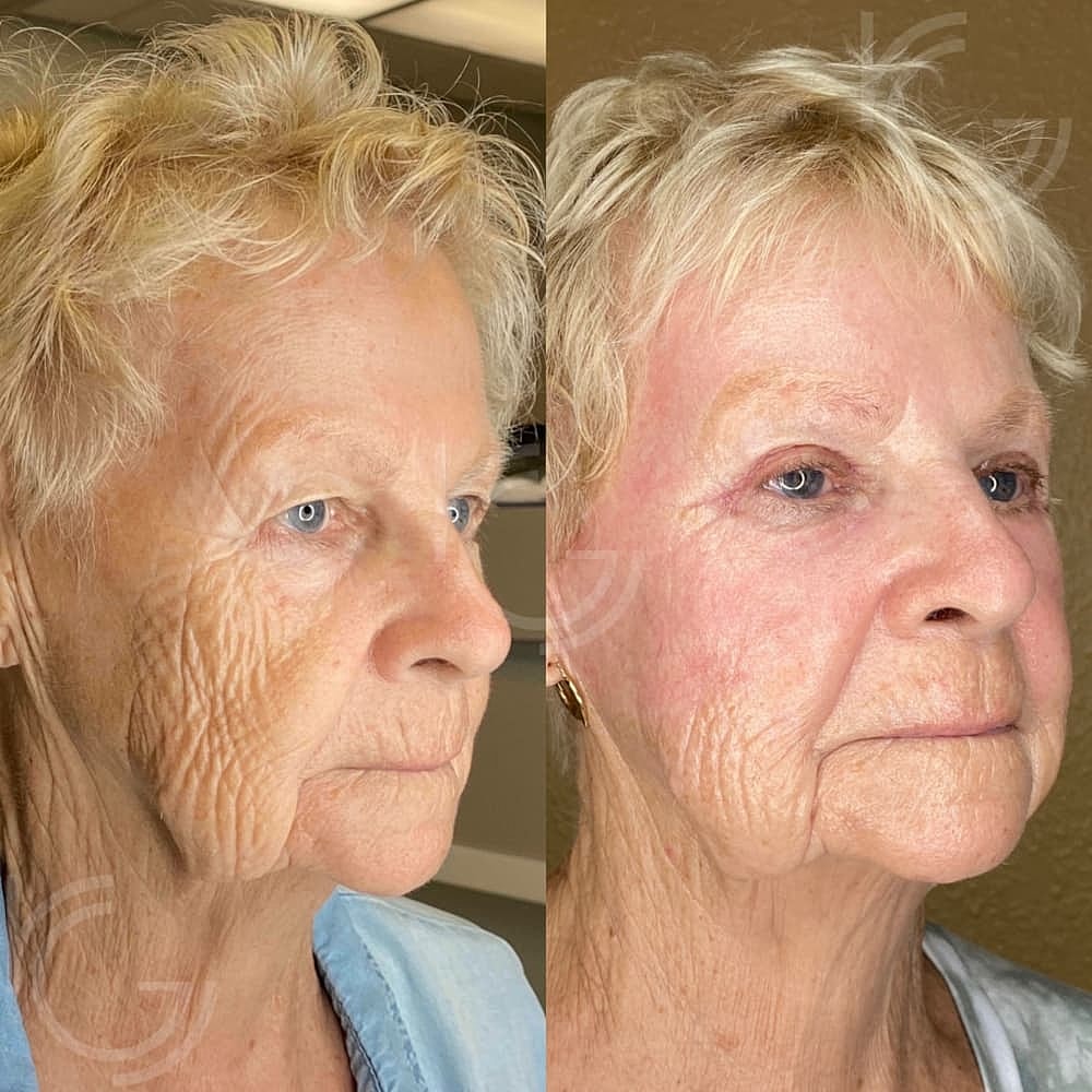 Upper Eyelid Surgery Before & After