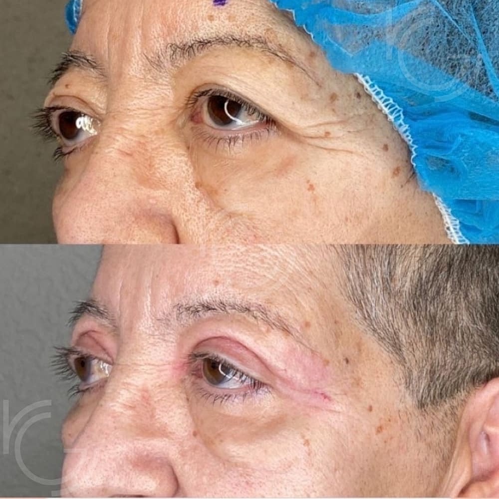Upper Eyelid Surgery Before & After