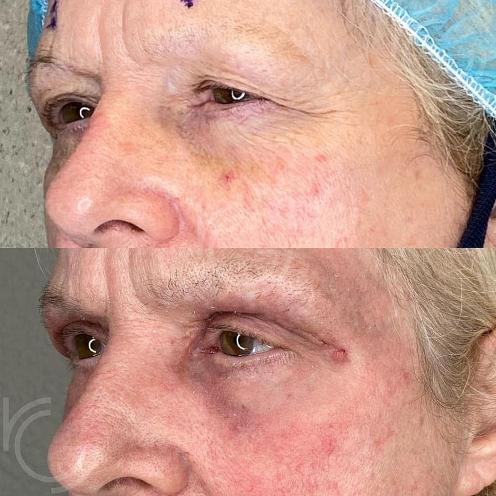 Upper Eyelid Surgery Before & After