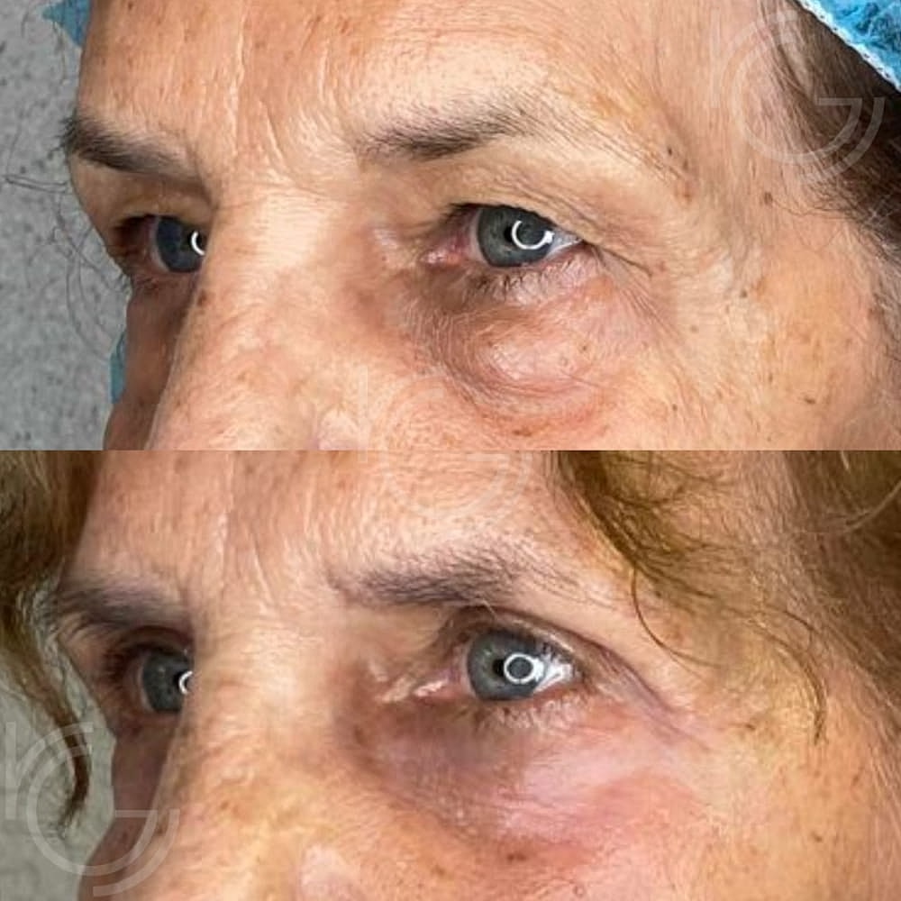 Upper Eyelid Surgery Before & After