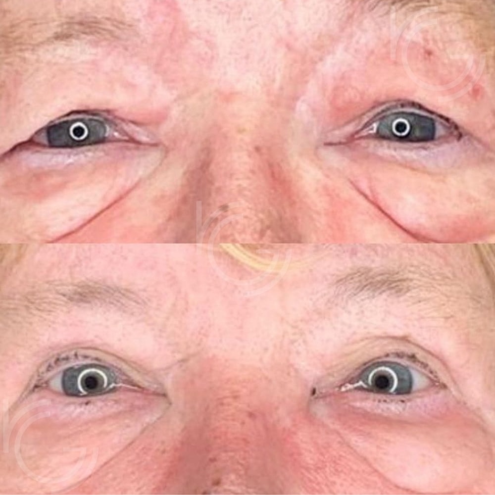 Upper Eyelid Surgery Before & After