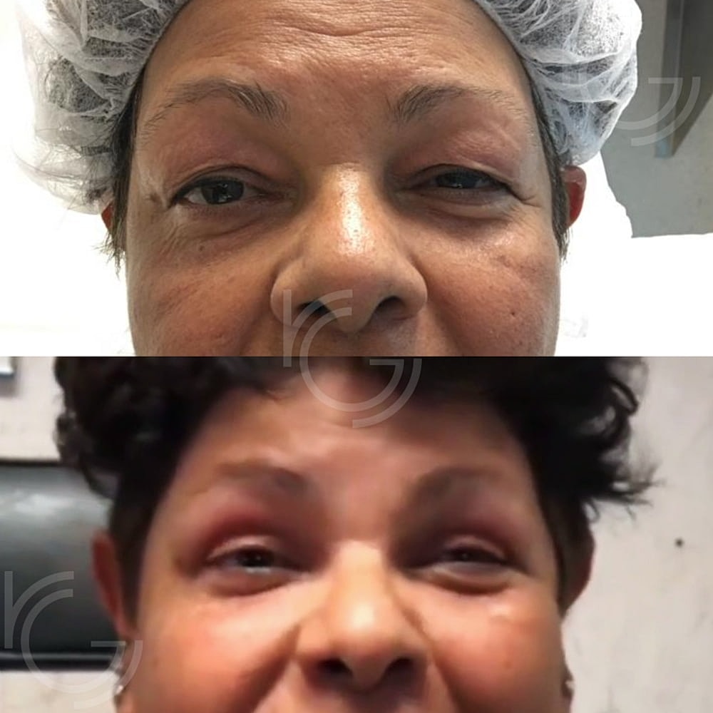 Upper Eyelid Surgery Before & After