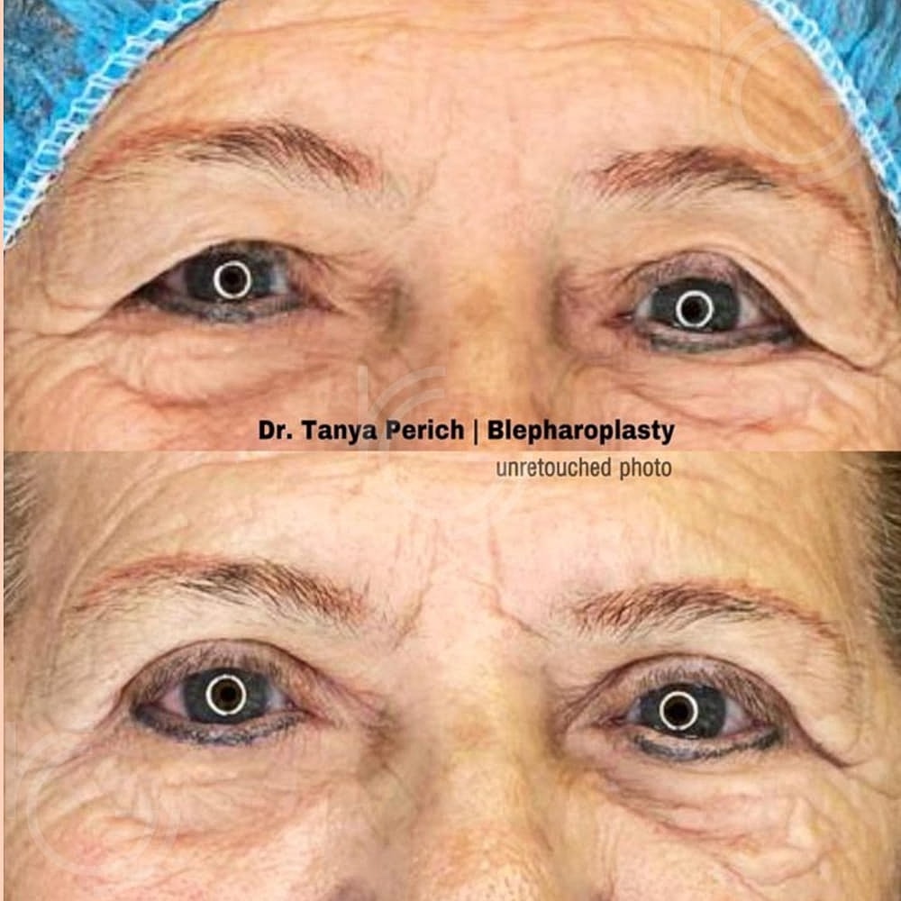 Upper Eyelid Surgery Before & After