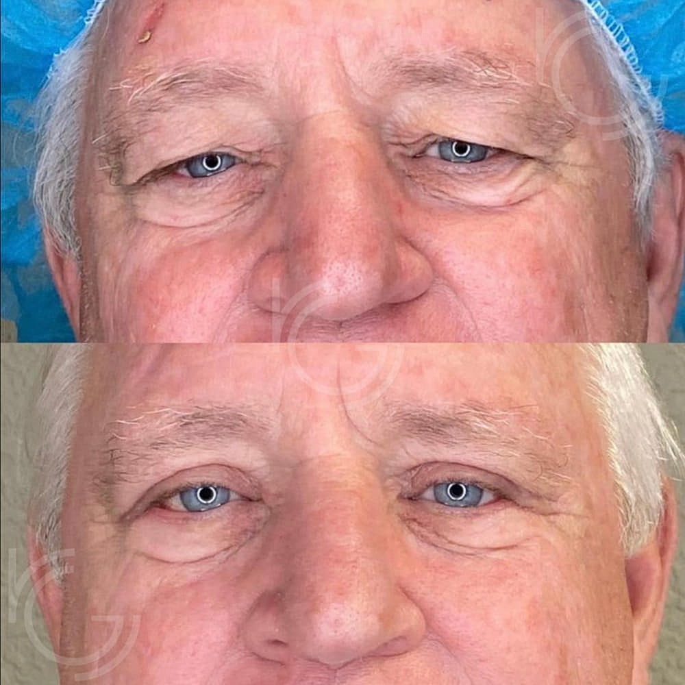 Upper Eyelid Surgery Before & After