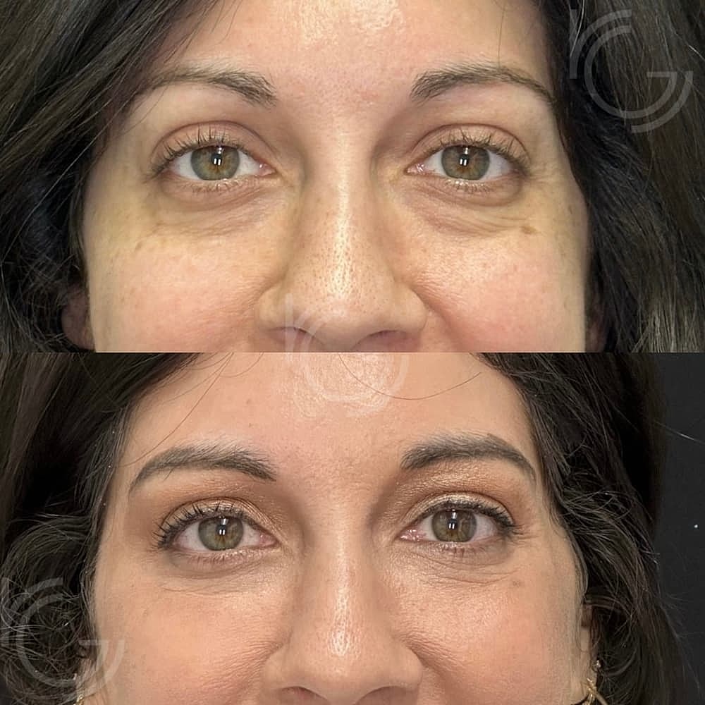 Lower Eyelid Surgery Before & After