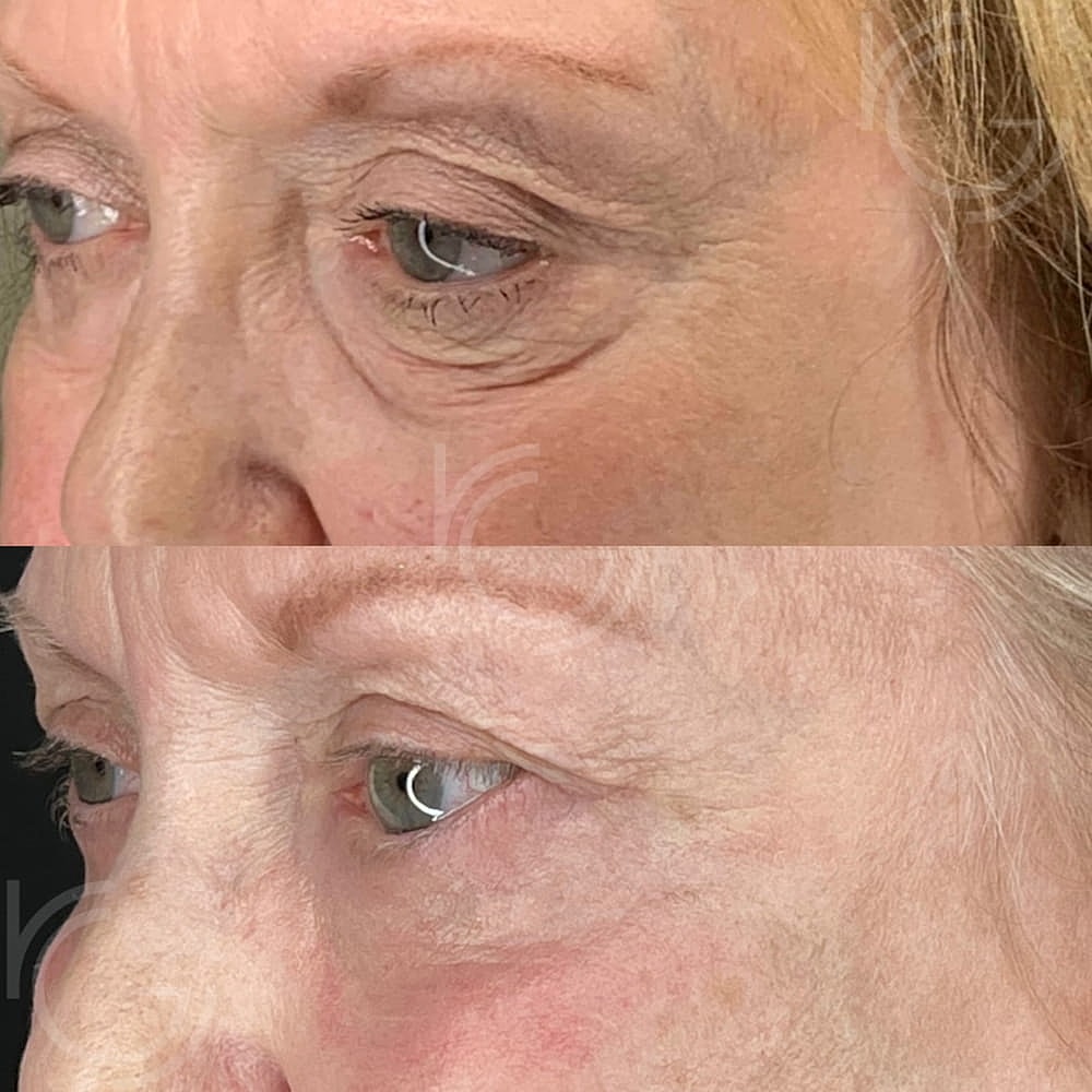 Lower Eyelid Surgery Before & After