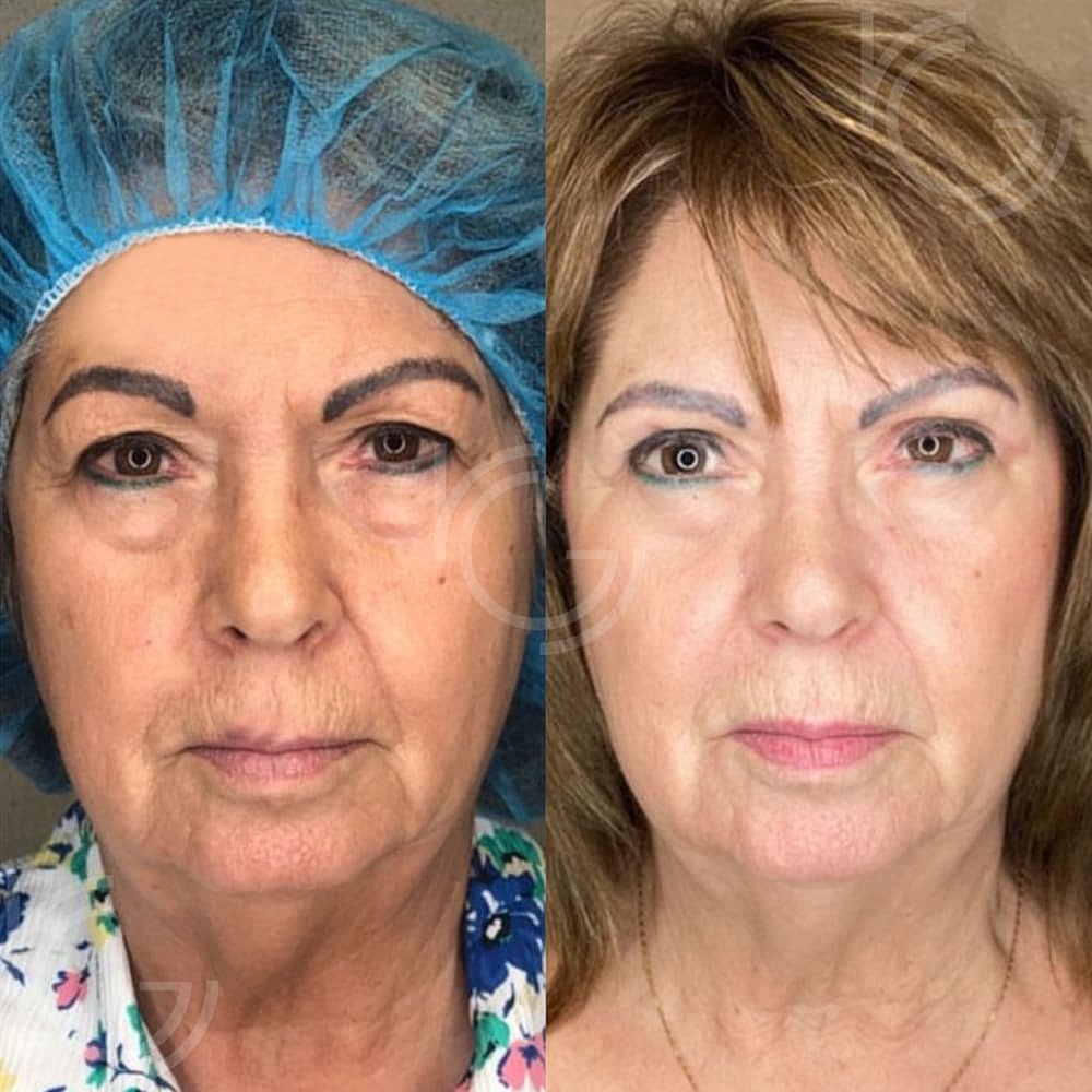 Lower Eyelid Surgery Before & After