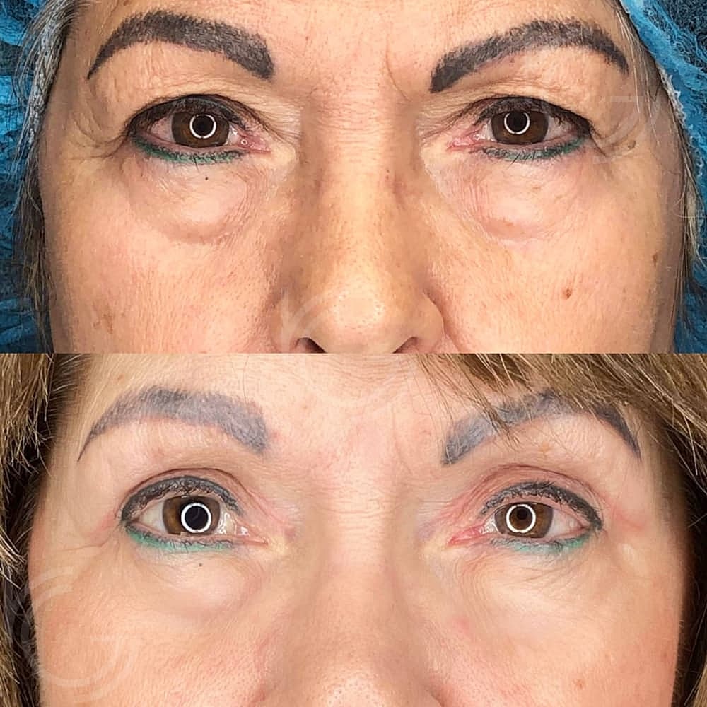 Lower Eyelid Surgery Before & After