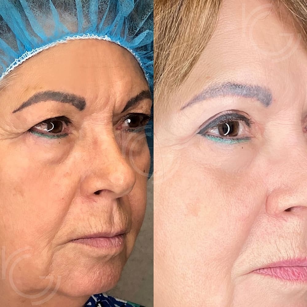 Lower Eyelid Surgery Before & After