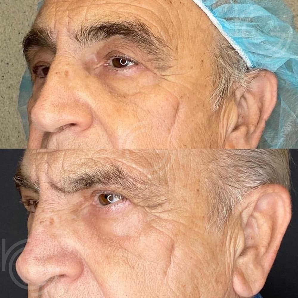 Lower Eyelid Surgery Before & After