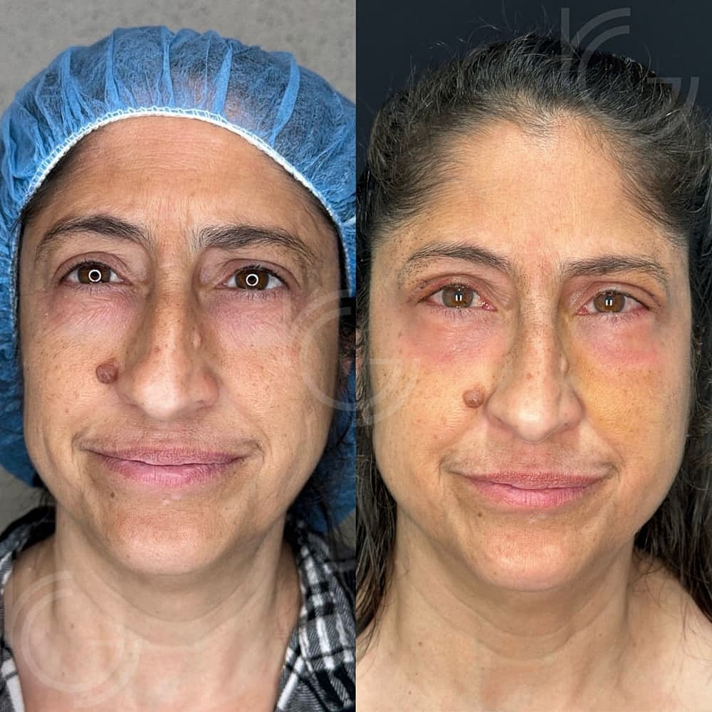 Lower Eyelid Surgery Before & After