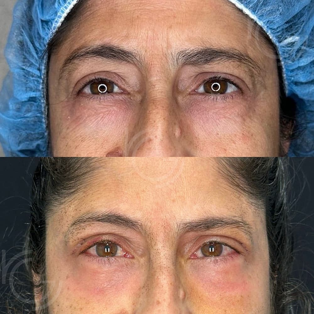 Lower Eyelid Surgery Before & After