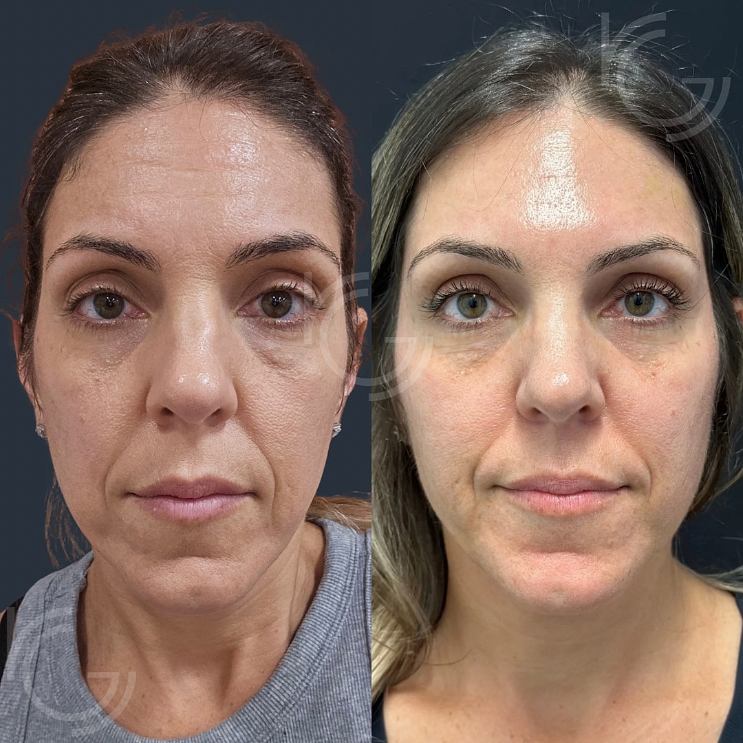 Dermal Fillers Before & After