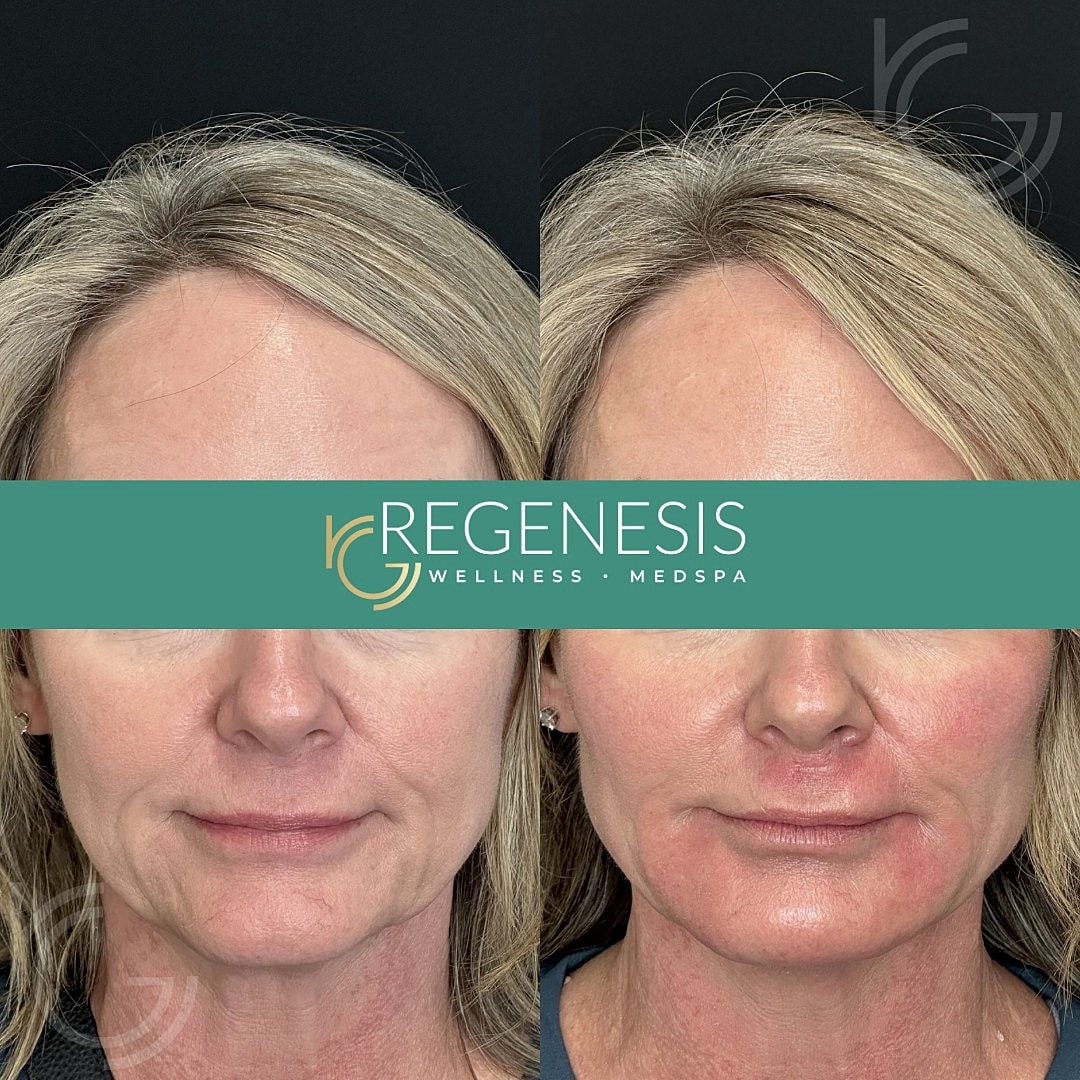 Dermal Fillers Before & After