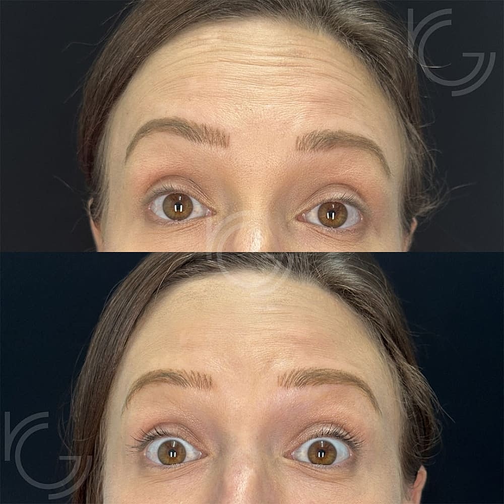 Botox Before & After