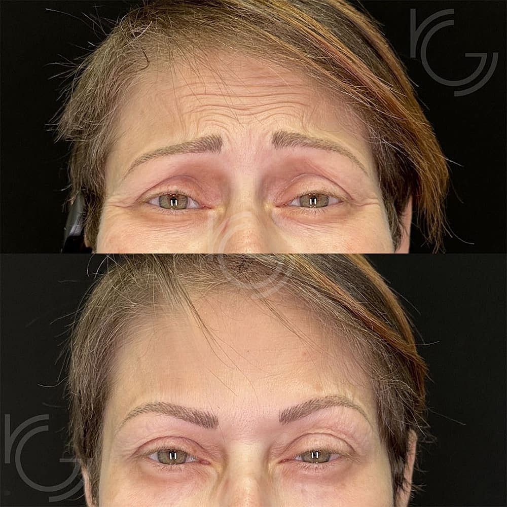 Botox Before & After