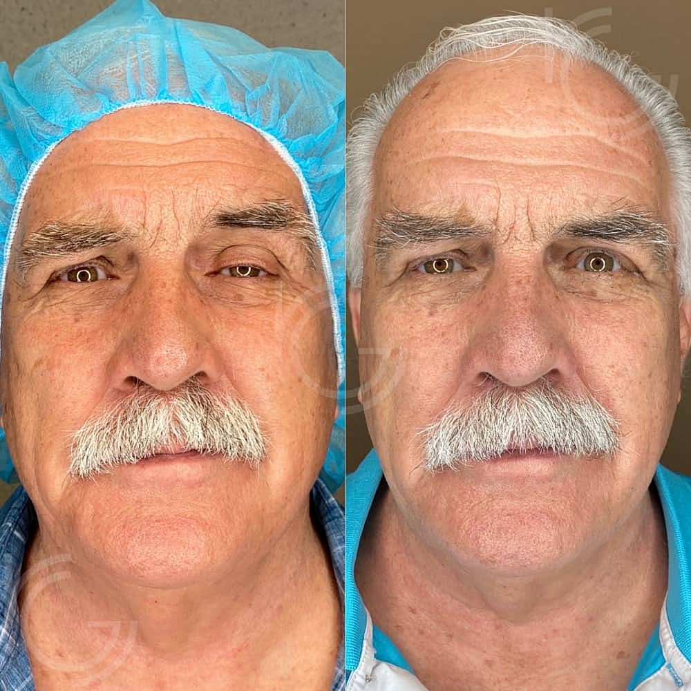 Ptosis Before & After