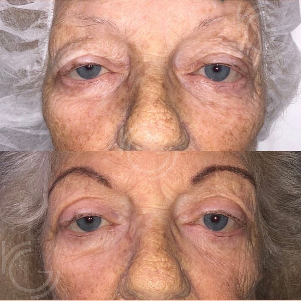 Ptosis Before & After