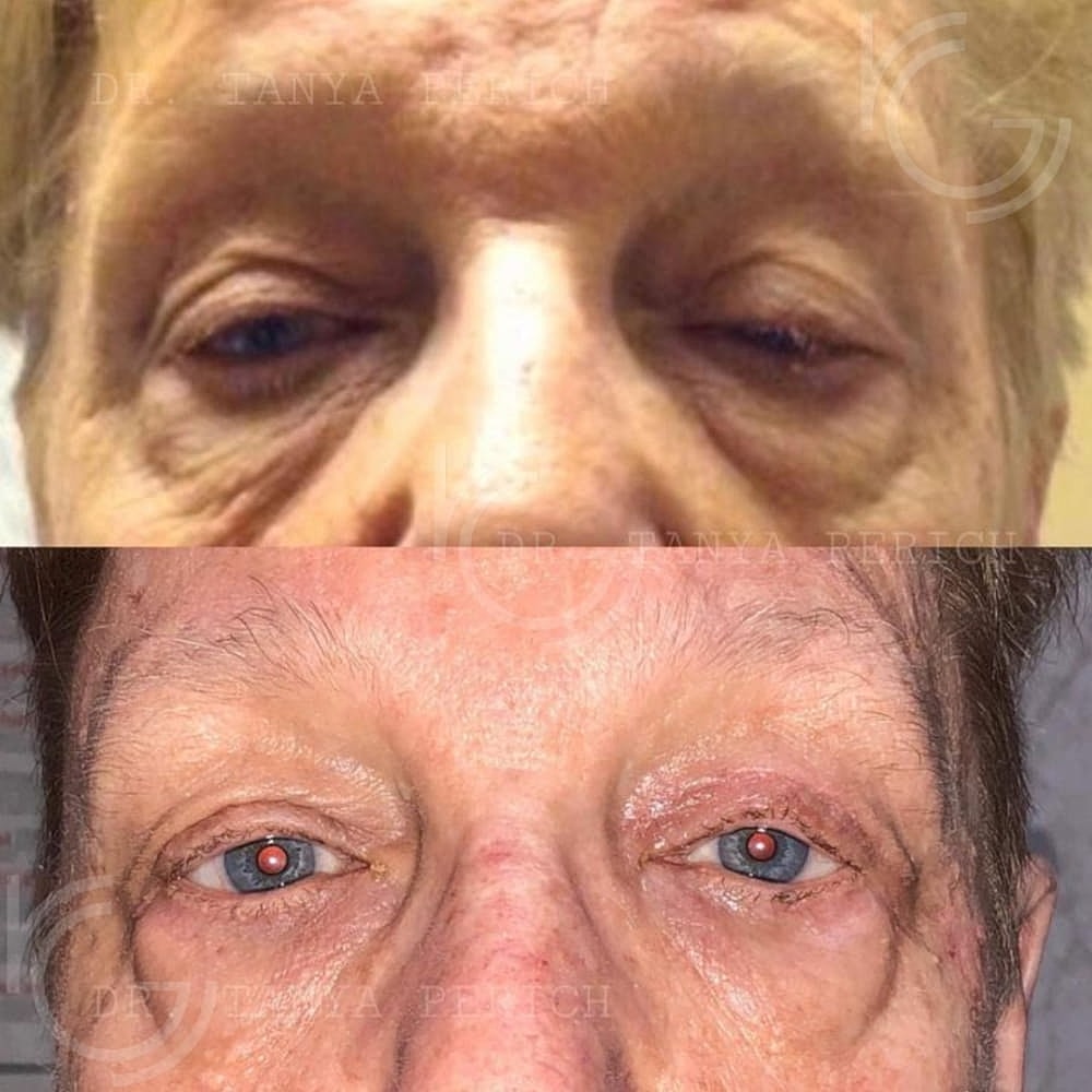Ptosis Before & After