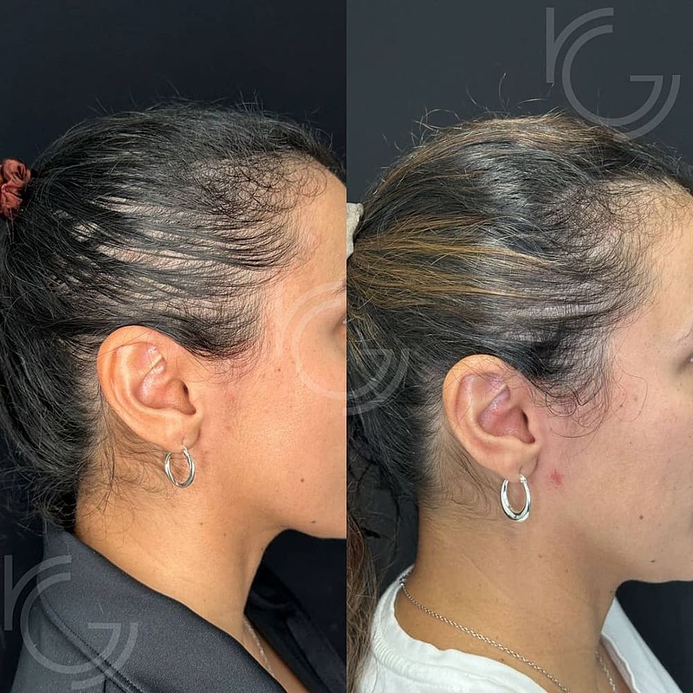 PRP/PRF Hair Restoration Before & After