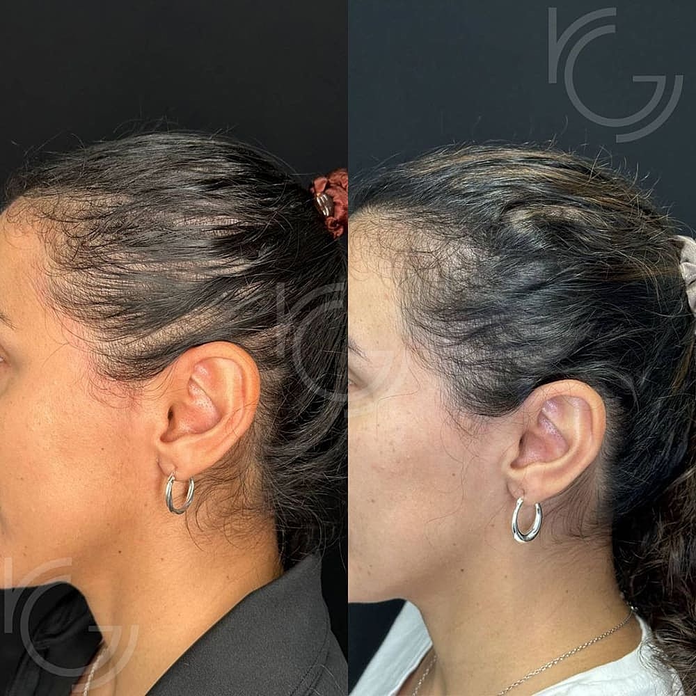 PRP/PRF Hair Restoration Before & After