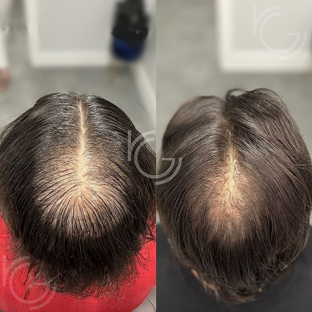 PRP/PRF Hair Restoration Before & After