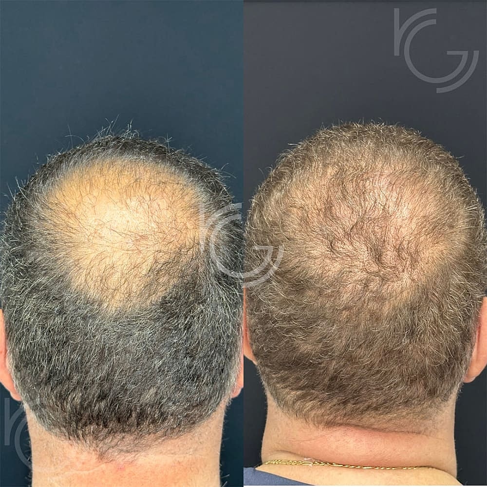 PRP/PRF Hair Restoration Before & After